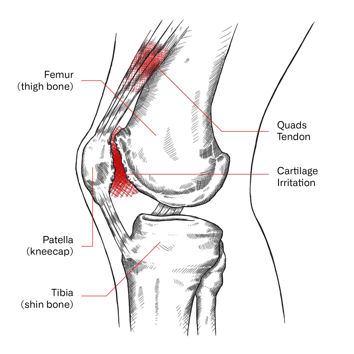 Runner's Knee
